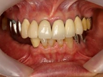 術前口腔内（正面観）