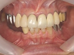 術前口腔内（正面観）