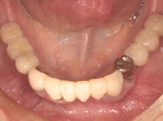 術後口腔内写真